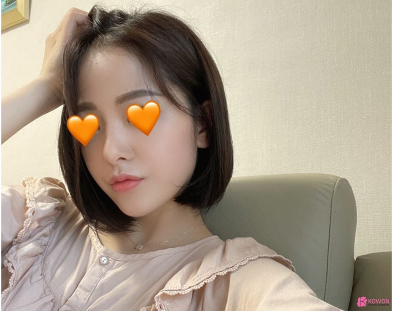 코성형외과추천 코필러후수술 3개월 차 비교 사진 사진 13
