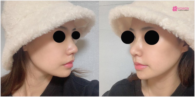 압구정코성형 여자 직반버선코 수술 경과와 후기 사진 9