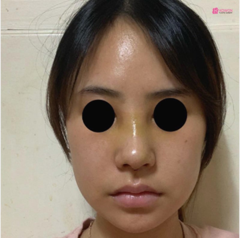 압구정코성형 여자 직반버선코 수술 경과와 후기 사진 8