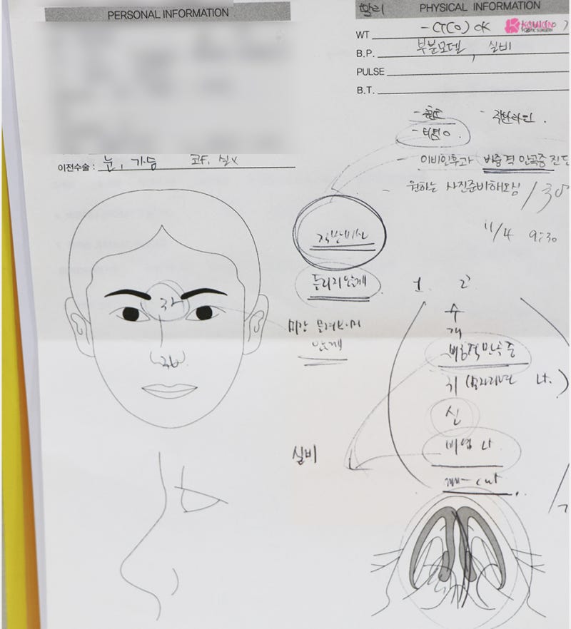 압구정코성형 여자 직반버선코 수술 경과와 후기 사진 3