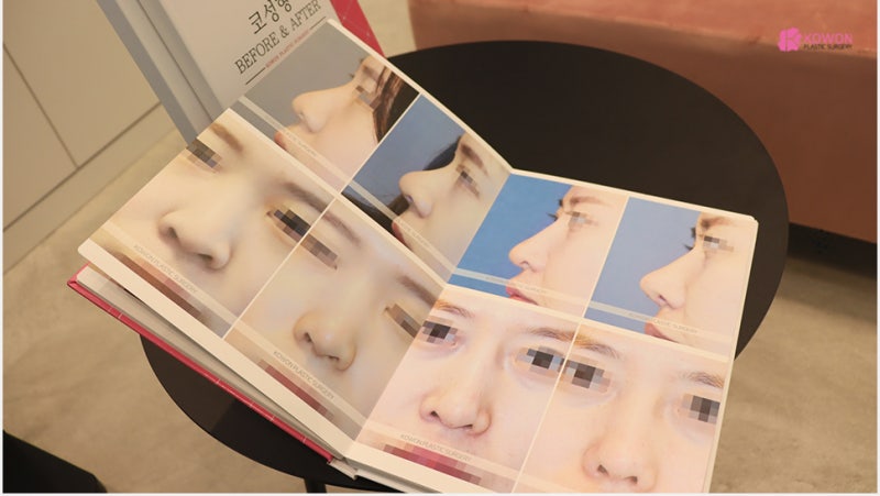 압구정코성형 여자 직반버선코 수술 경과와 후기 사진 2