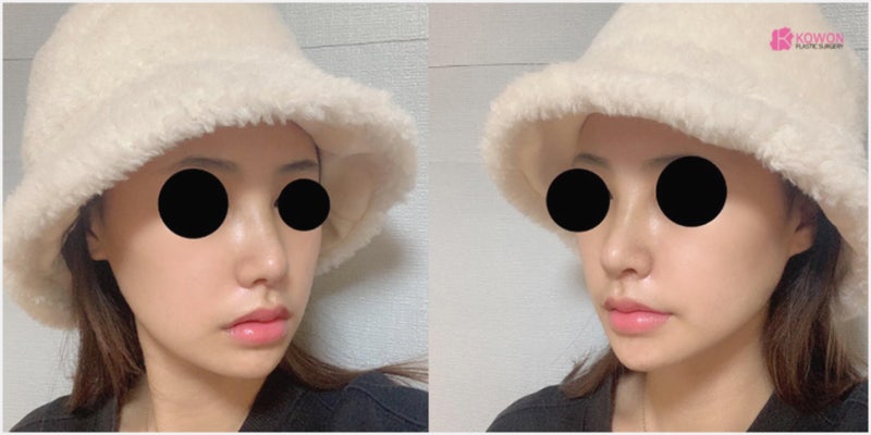 압구정코성형 여자 직반버선코 수술 경과와 후기 사진 10