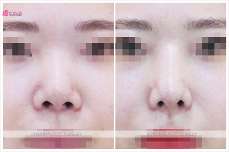 코성형잘하는곳추천 자가늑을 이용한 콧등수술