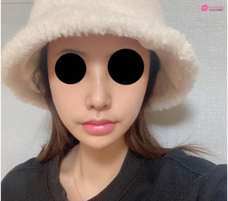 신사역성형외과 코성형비중격만곡증 만족스러운 결과 사진 10