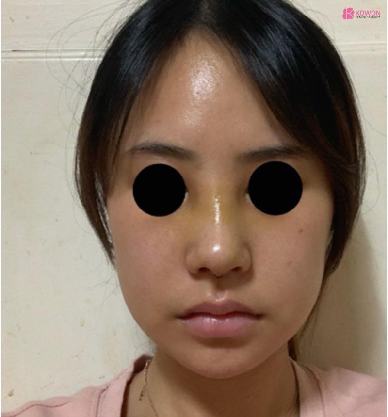 신사역성형외과 코성형비중격만곡증 만족스러운 결과 사진 7