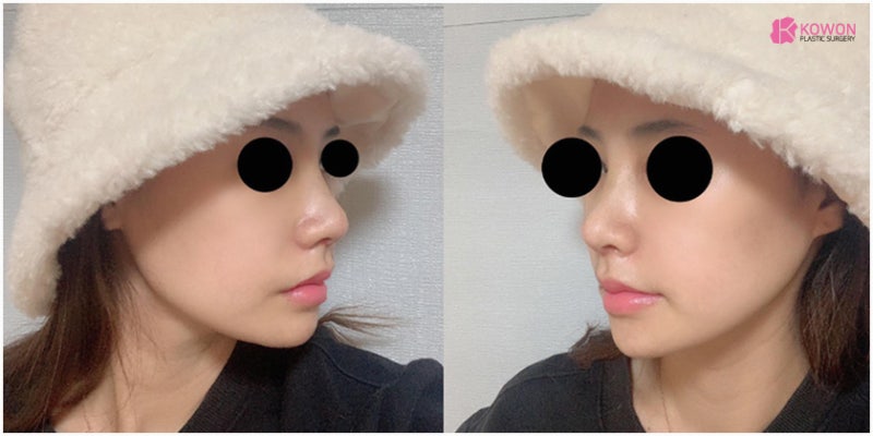 신사역성형외과 코성형비중격만곡증 만족스러운 결과 사진 8