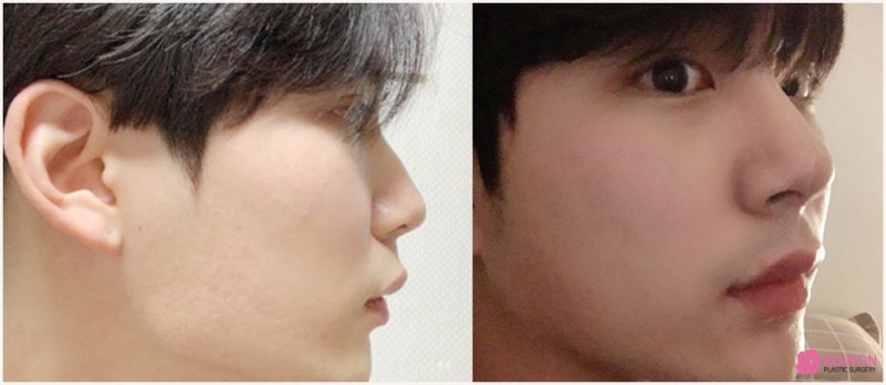코성형전후 남성적인 코로 바뀐 매부리코교정술 방법