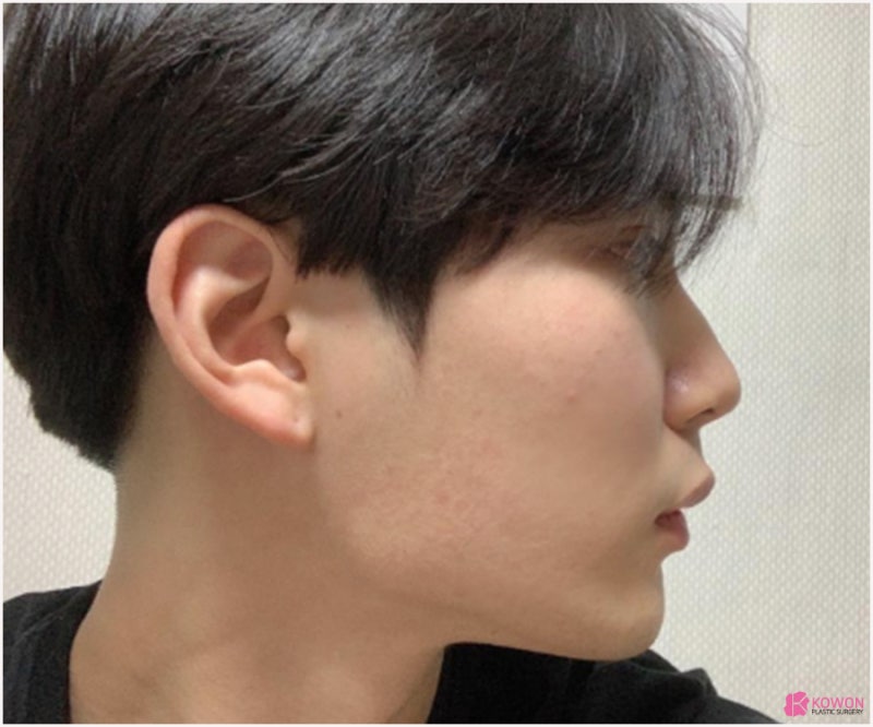 코성형전후 남성적인 코로 바뀐 매부리코교정술 방법 사진 4