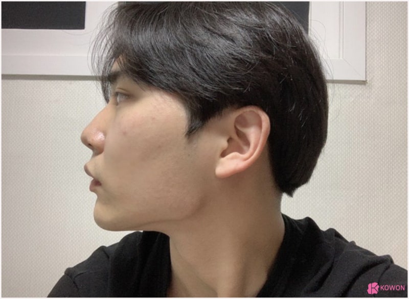 코성형전후 남성적인 코로 바뀐 매부리코교정술 방법 사진 3