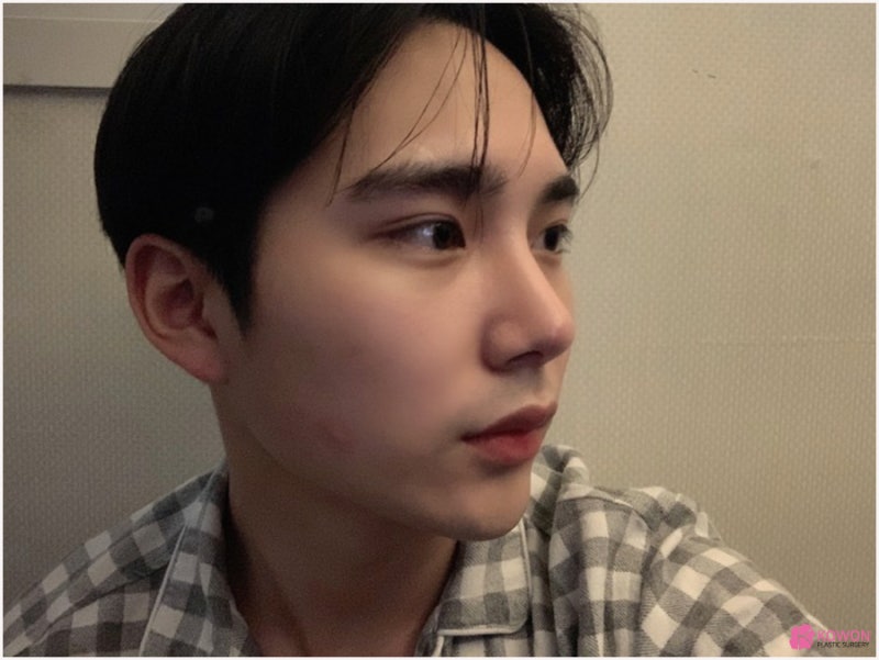 코성형전후 남성적인 코로 바뀐 매부리코교정술 방법 사진 5