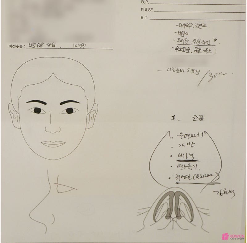 코성형전후 남성적인 코로 바뀐 매부리코교정술 방법 사진 2