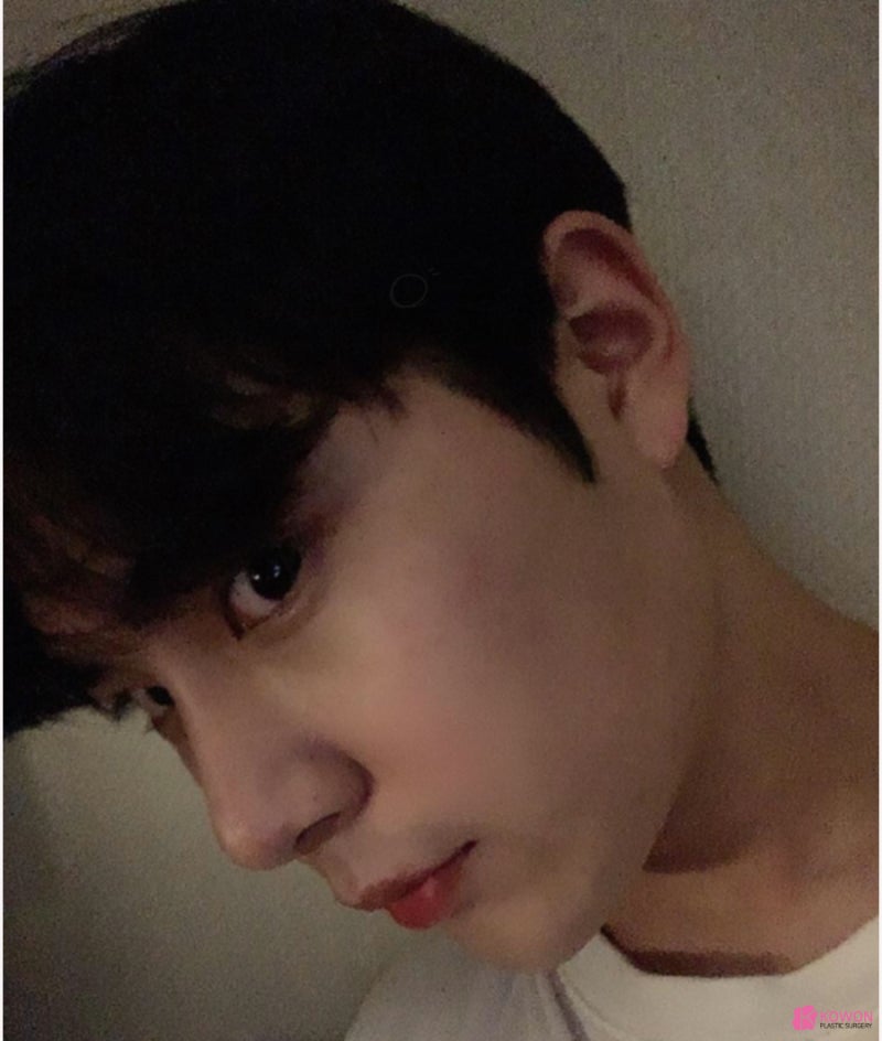 코성형전후 남성적인 코로 바뀐 매부리코교정술 방법 사진 8