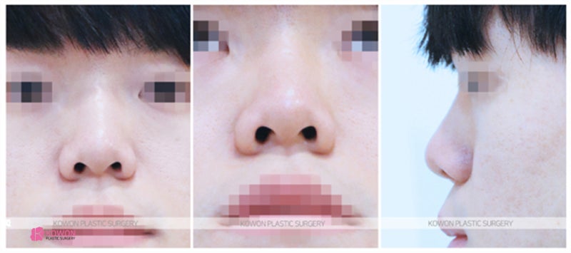 신사역근처성형외과 남자코성형전후 이미지 차이 사진 2