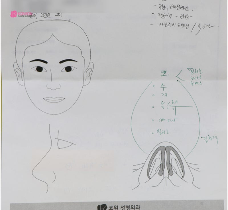 강남성형외과순위 높은 곳에서 처진 화살코수술