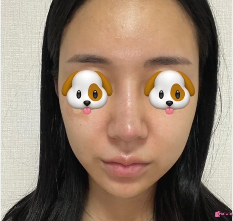 코수술잘하는병원 코끝 라인 비순각성형 후기 사진 7