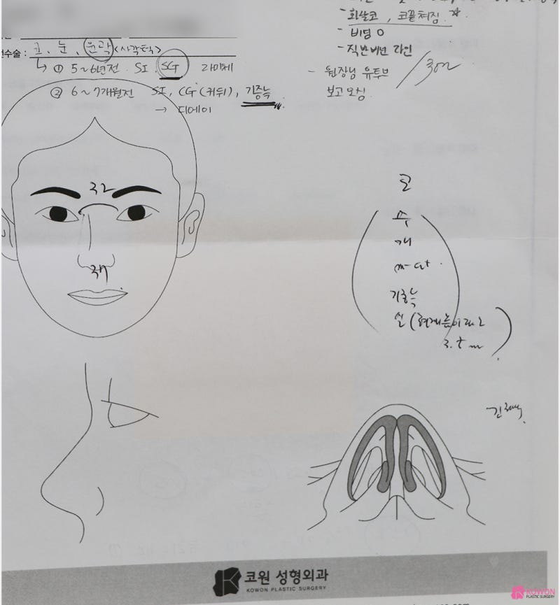 코수술잘하는병원 코끝 라인 비순각성형 후기