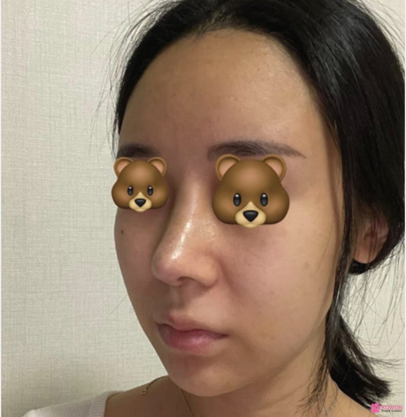 코수술잘하는병원 코끝 라인 비순각성형 후기 사진 5