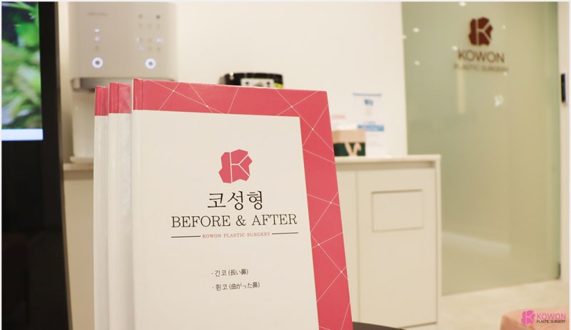코수술잘하는병원 코끝 라인 비순각성형 후기 사진 11