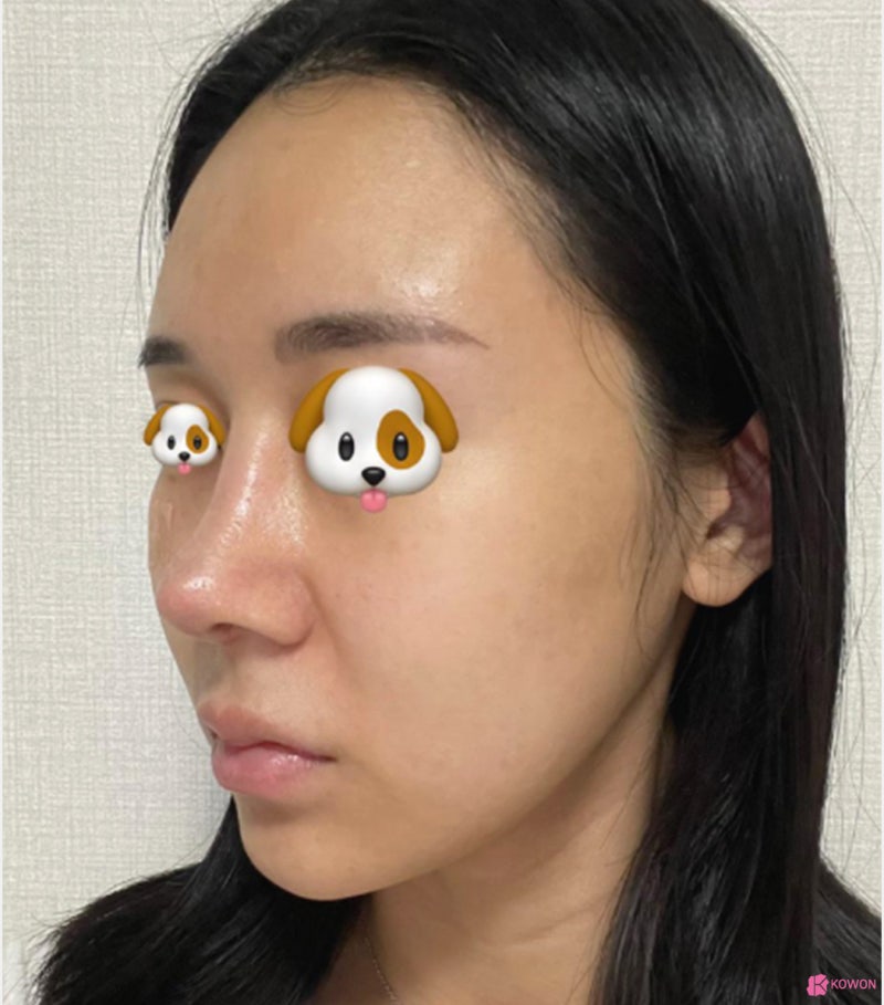 코수술잘하는병원 코끝 라인 비순각성형 후기 사진 9