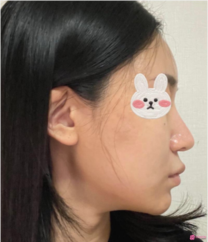 코수술잘하는병원 코끝 라인 비순각성형 후기 사진 4