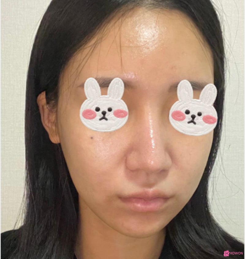 코수술잘하는병원 코끝 라인 비순각성형 후기 사진 3