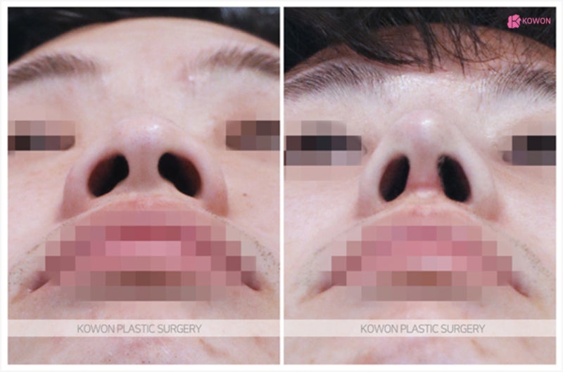 코수술전후 비교 주먹코성형 비절개 방법 사진 4