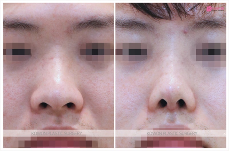 코수술전후 비교 주먹코성형 비절개 방법 사진 6