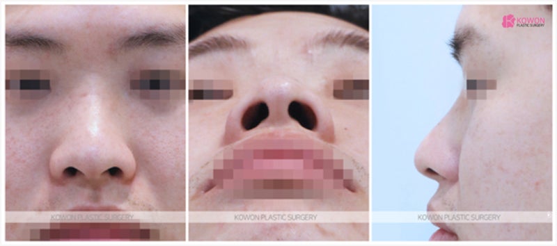 코수술전후 비교 주먹코성형 비절개 방법