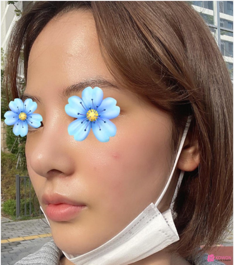 여자코성형전후 차이 짧은코수술 고민 해결 사진 9