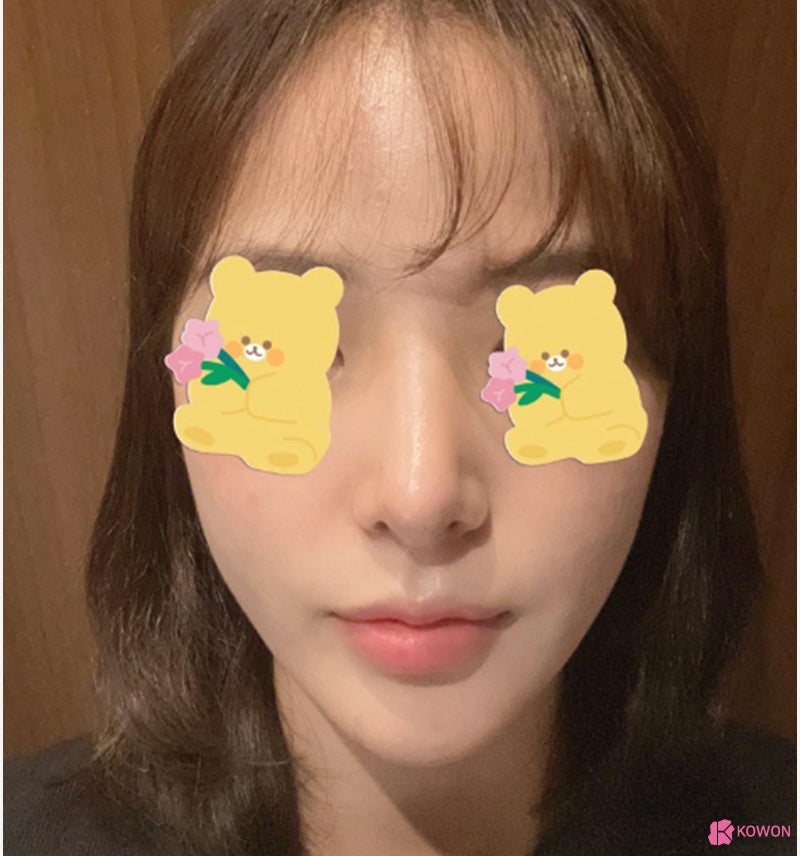 여자코성형전후 차이 짧은코수술 고민 해결 사진 7