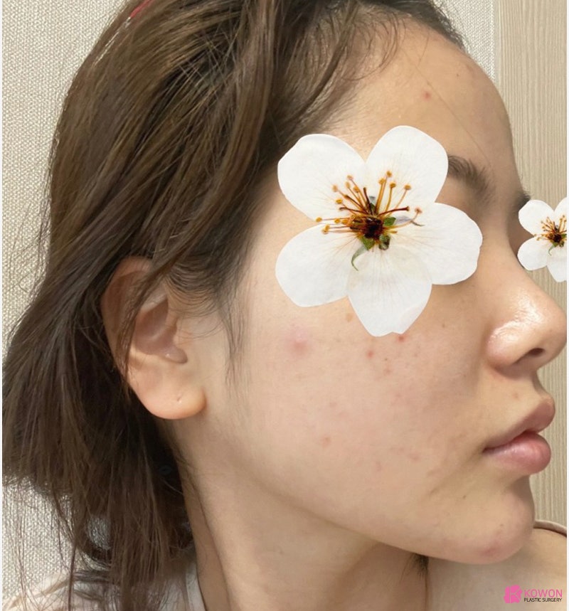 여자코성형전후 차이 짧은코수술 고민 해결 사진 4