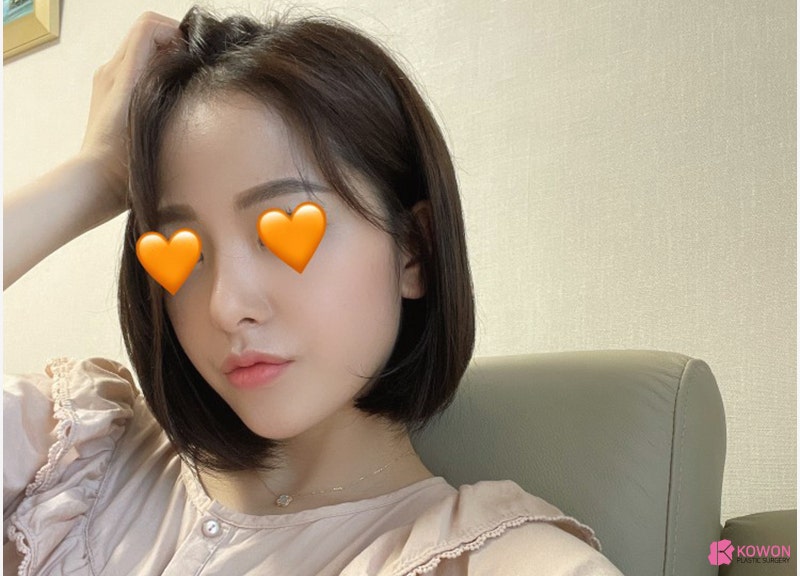 여자코성형전후 차이 짧은코수술 고민 해결 사진 13