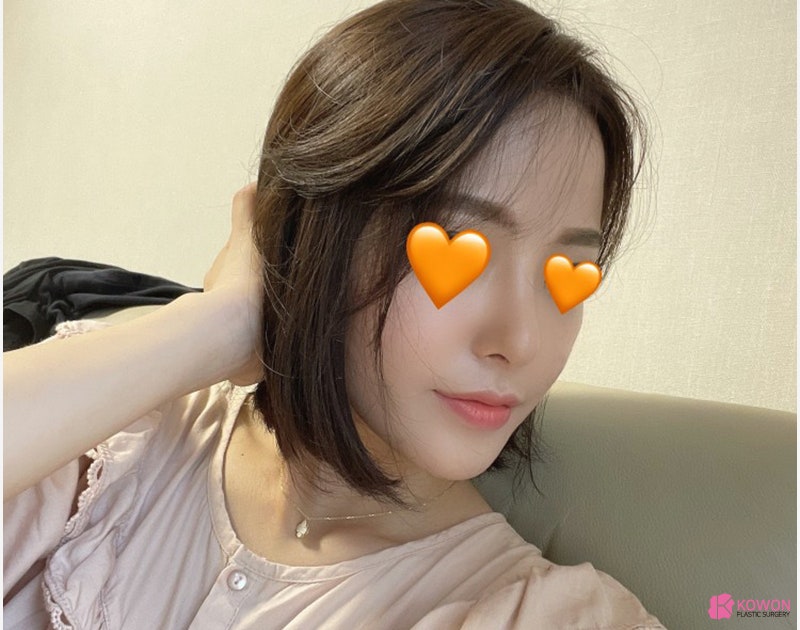 여자코성형전후 차이 짧은코수술 고민 해결 사진 11
