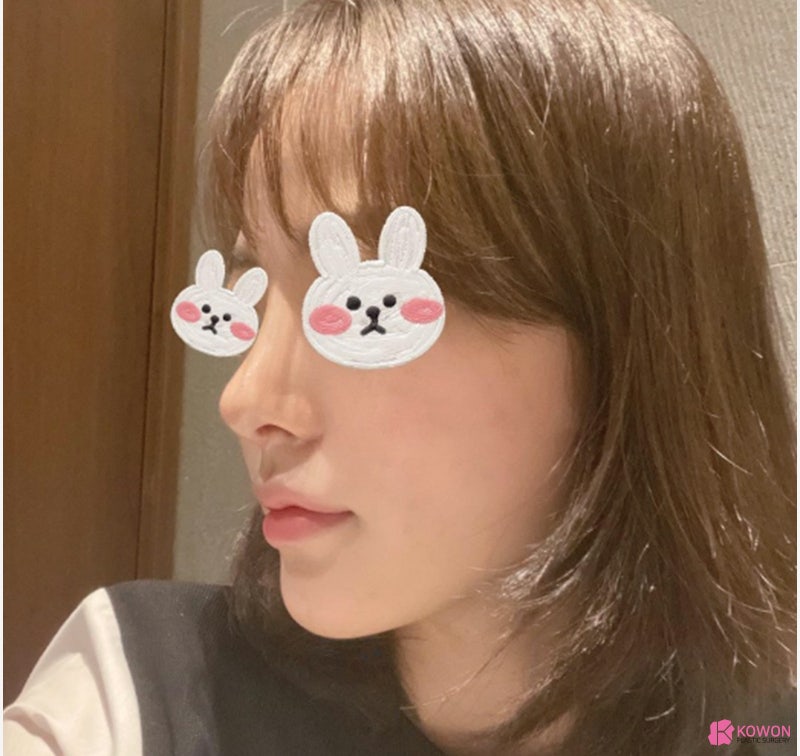 여자코성형전후 차이 짧은코수술 고민 해결 사진 6