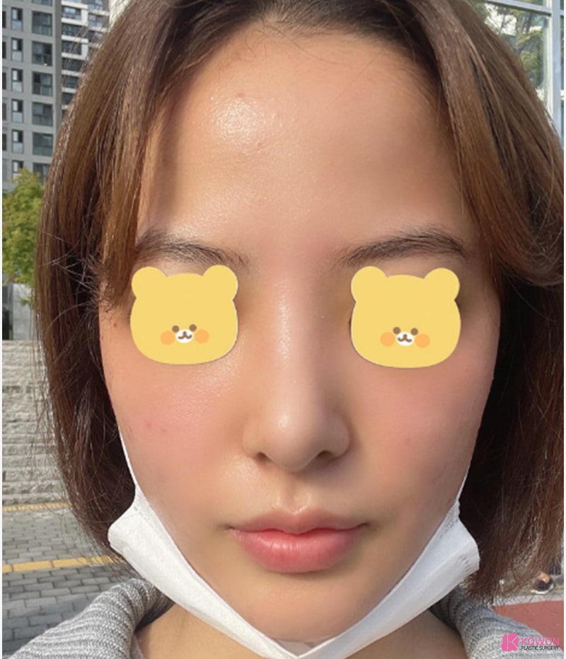 여자코성형전후 차이 짧은코수술 고민 해결 사진 10