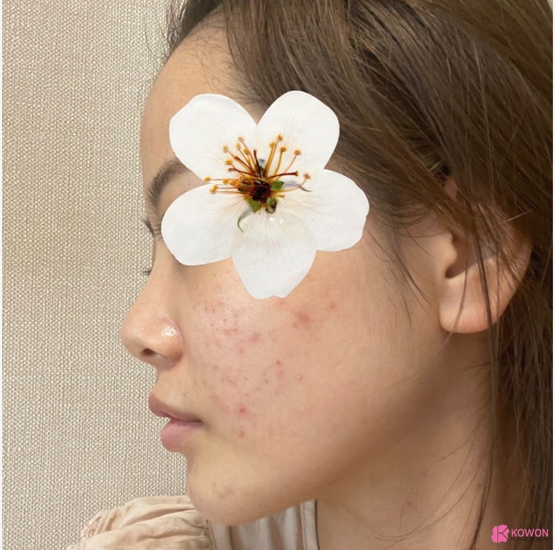 여자코성형전후 차이 짧은코수술 고민 해결