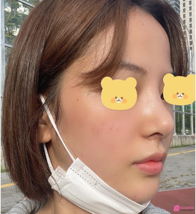 여자코성형전후 차이 짧은코수술 고민 해결 사진 8