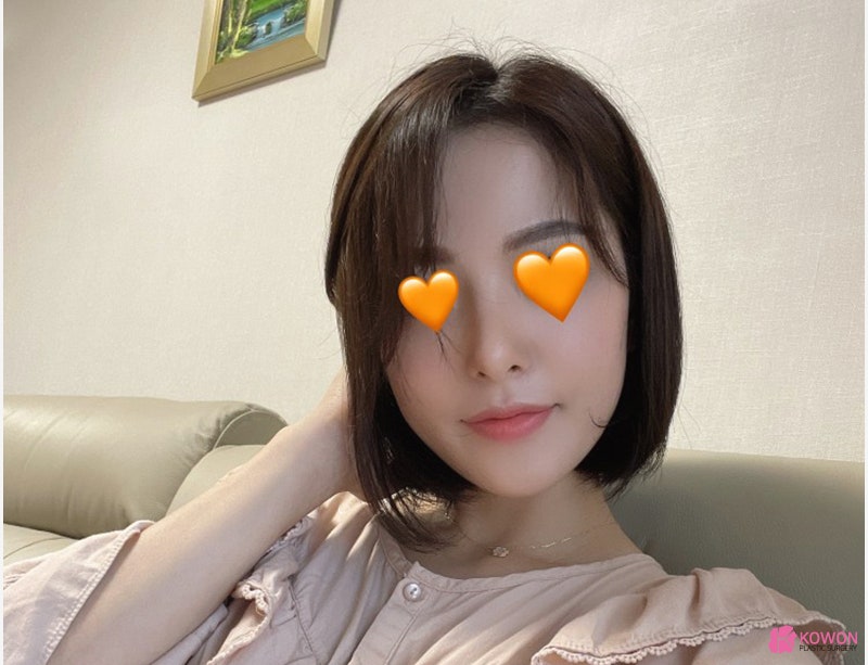 여자코성형전후 차이 짧은코수술 고민 해결 사진 12