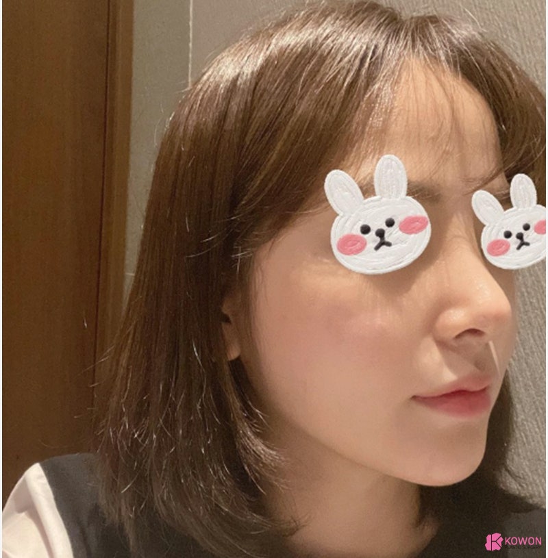 여자코성형전후 차이 짧은코수술 고민 해결 사진 5