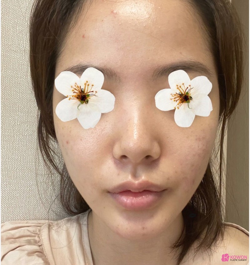 여자코성형전후 차이 짧은코수술 고민 해결 사진 3