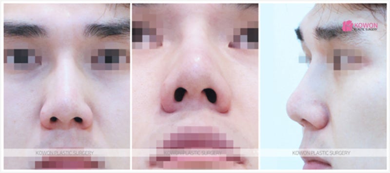 역삼동성형외과 코필러꺼짐 재수술 진행한 방법