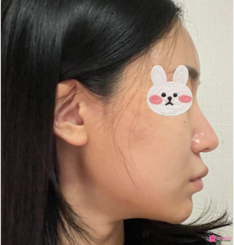 여자화살코 성형 코수술항생제 알레르기 사전 대비 사진 4
