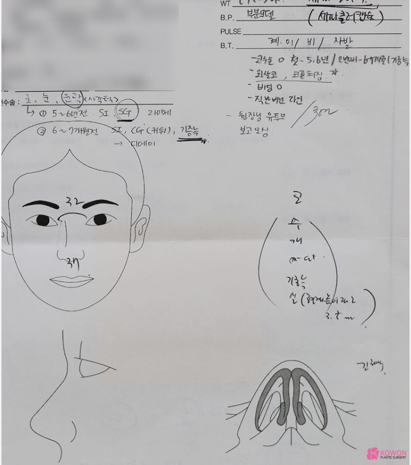 여자화살코 성형 코수술항생제 알레르기 사전 대비 사진 2