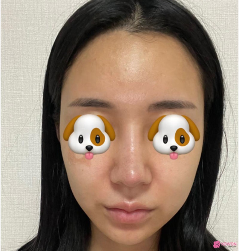 여자화살코 성형 코수술항생제 알레르기 사전 대비 사진 7
