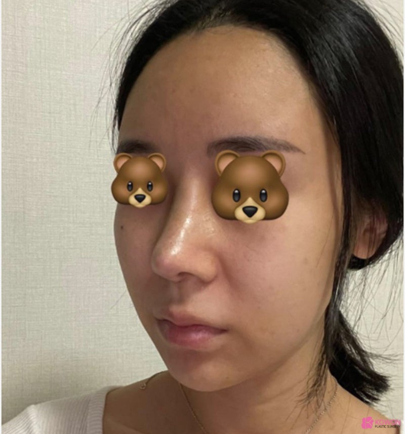 여자화살코 성형 코수술항생제 알레르기 사전 대비 사진 5