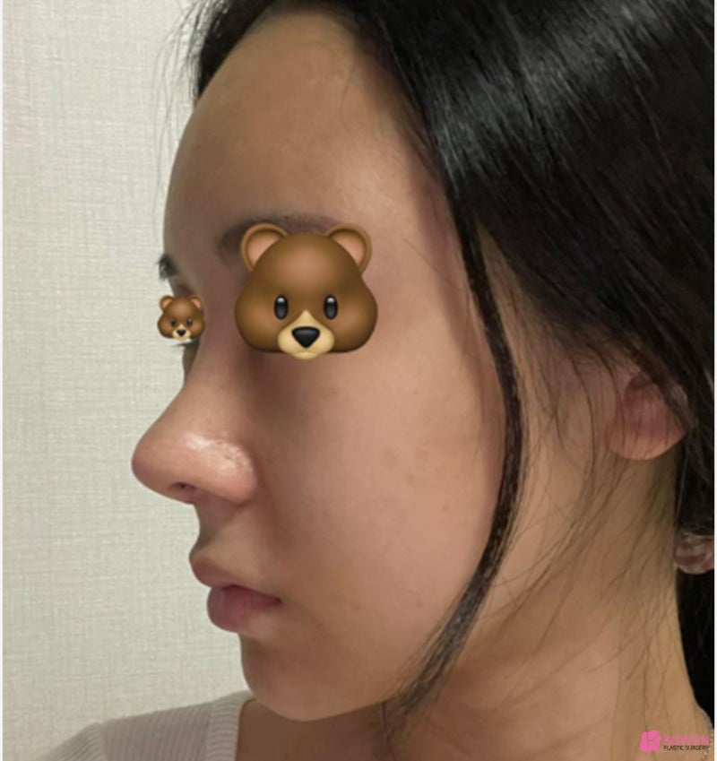 여자화살코 성형 코수술항생제 알레르기 사전 대비 사진 6