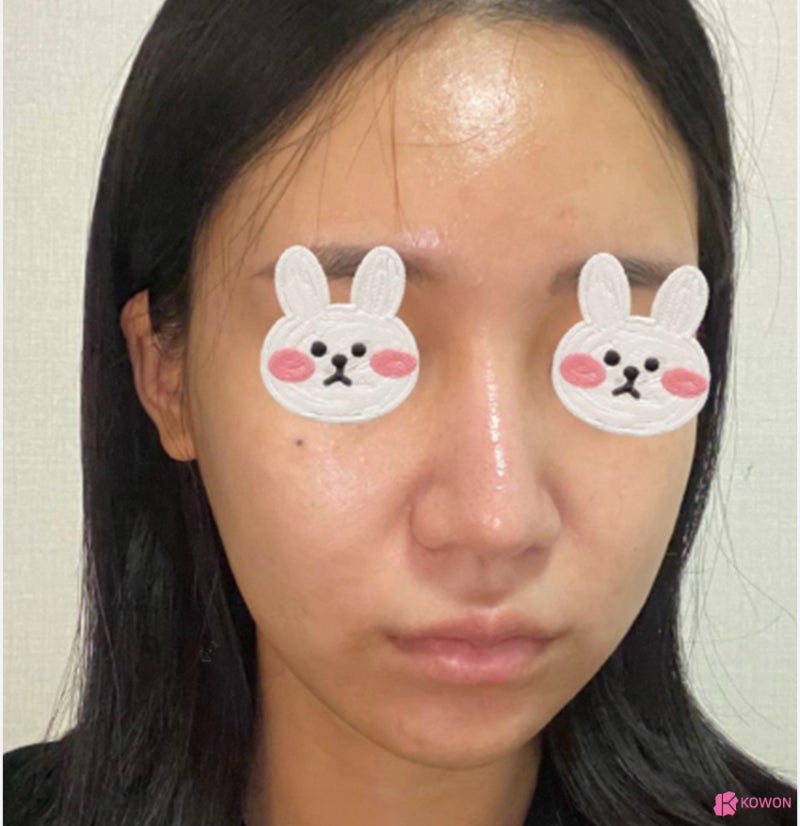 여자화살코 성형 코수술항생제 알레르기 사전 대비 사진 3