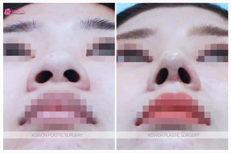 신사동성형외과 여자 뭉뚝한 복코수술후기 사진 3