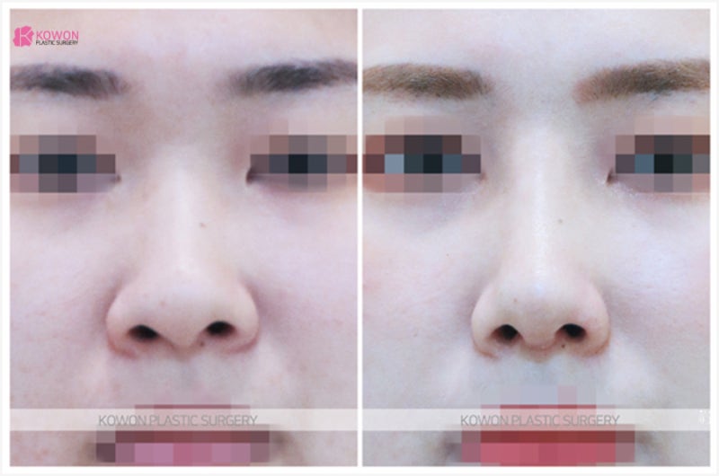 신사동성형외과 여자 뭉뚝한 복코수술후기 사진 5