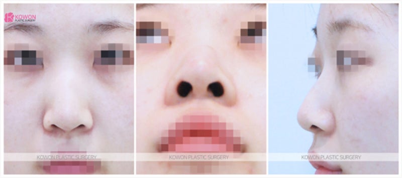 코수술잘하는곳 자연스러운 긴코성형 사례